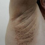 If you have purple veins on your legs, it means you are…